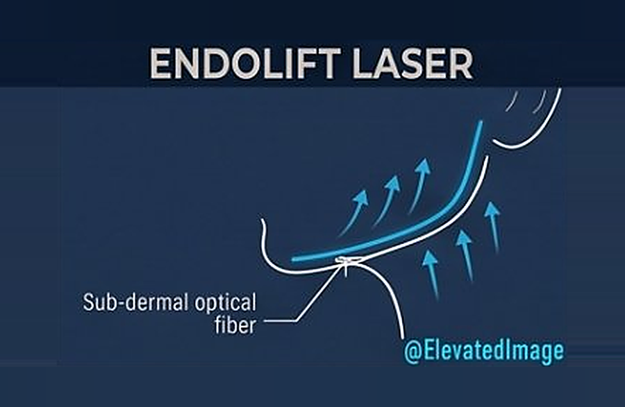 eic 01 endolift laser r2