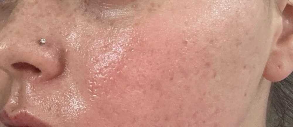 eic co2 resurfacing after