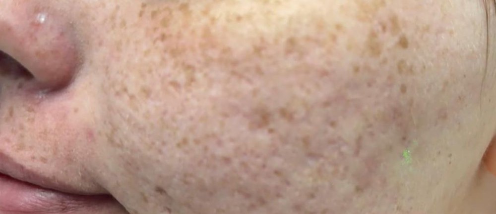 eic co2 resurfacing before