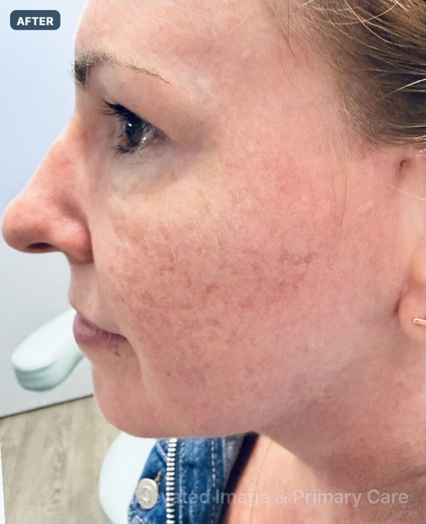 Endolift with suture suspension — three weeks after treatment, left profile — after