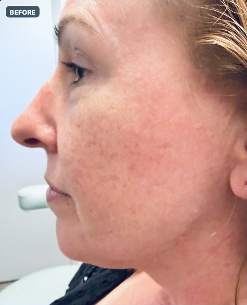 Endolift with suture suspension — three weeks after treatment, left profile — before