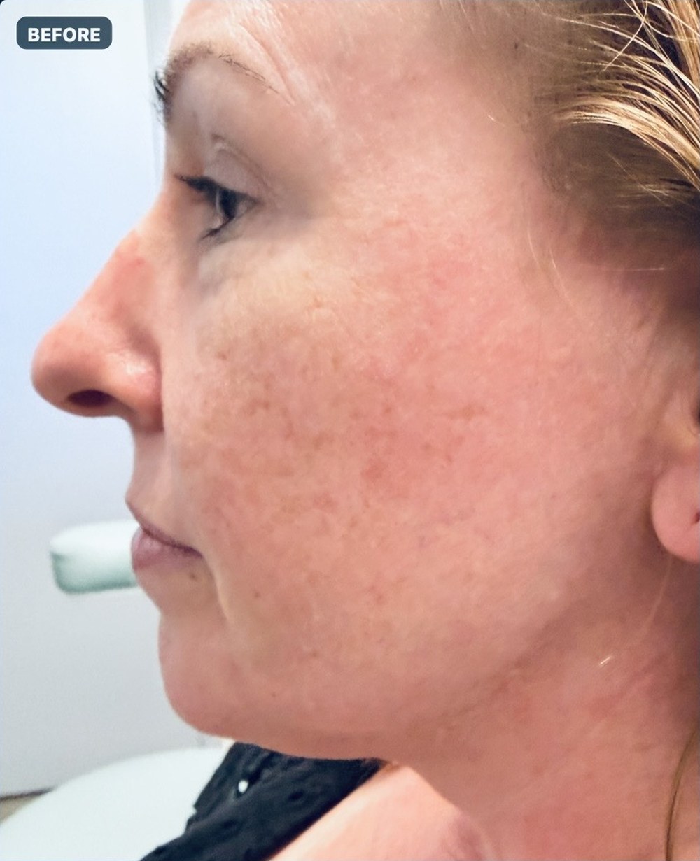 Endolift with suture suspension — three weeks after treatment, left profile — before
