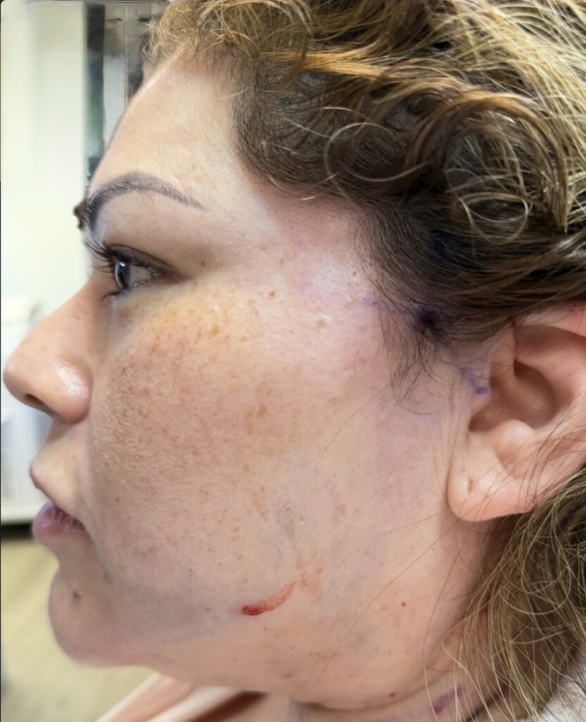 Endolift with suture suspension — three months after treatment, left profile — before