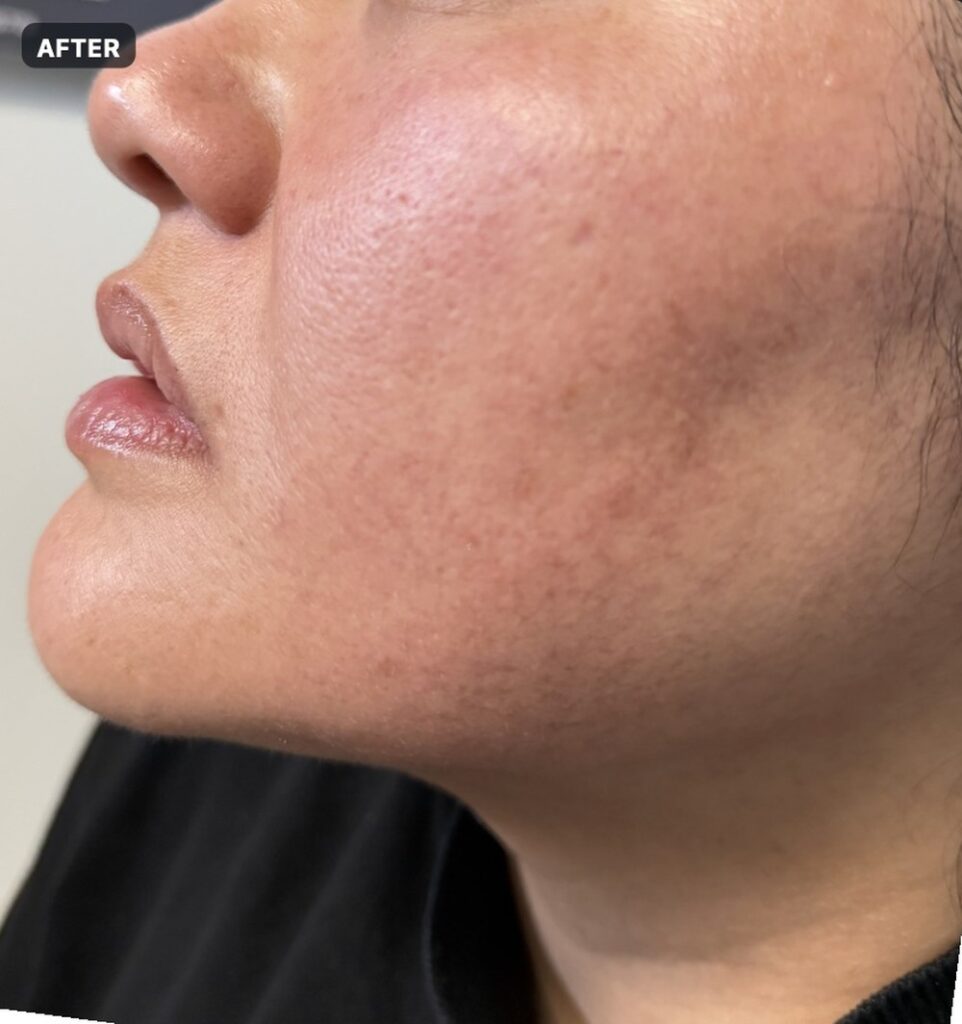 Endolift — three months after treatment, jawline and neck — after