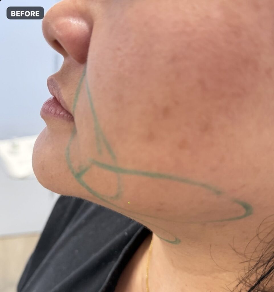 Endolift — three months after treatment, jawline and neck — before