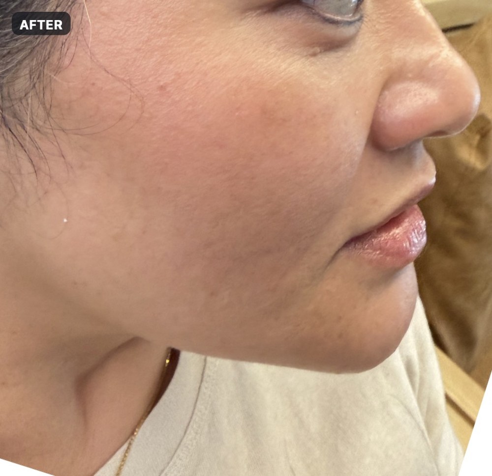Endolift — three months after treatment, jawline, left side — after