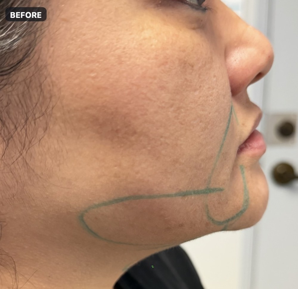 Endolift — three months after treatment, jawline, left side — before