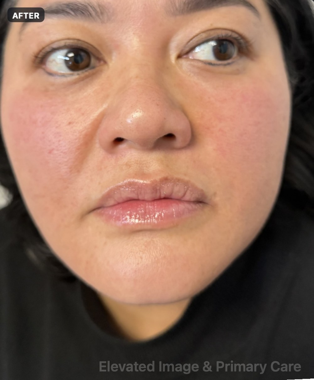 Endolift — three months after treatment, frontal view — after