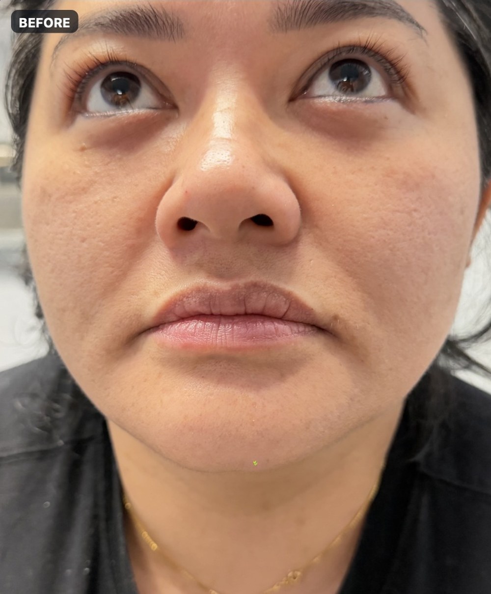 Endolift — three months after treatment, frontal view — before