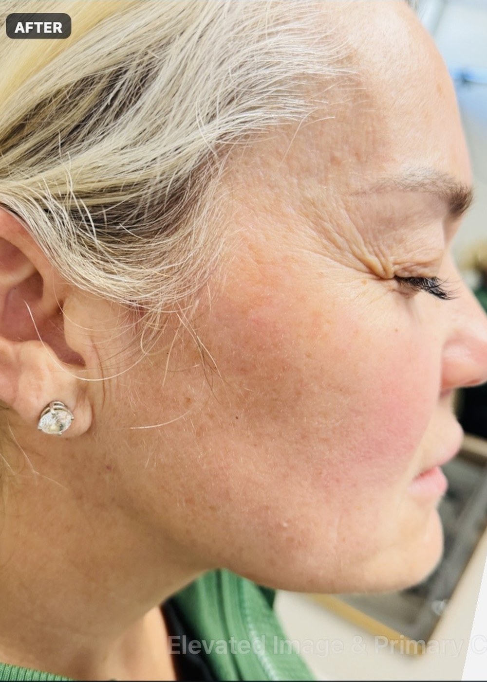 Endolift with suture suspension — two months after treatment — after