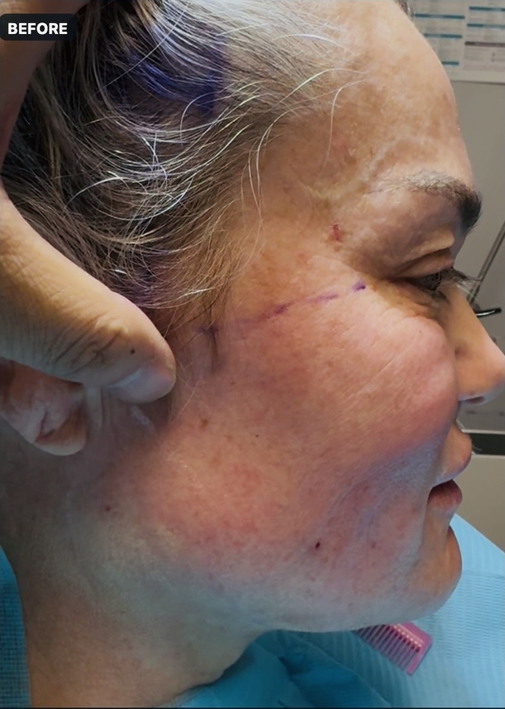 Endolift with suture suspension — two months after treatment — before