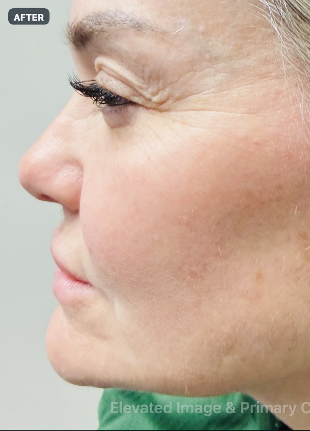 Endolift with suture suspension — two months after treatment — after