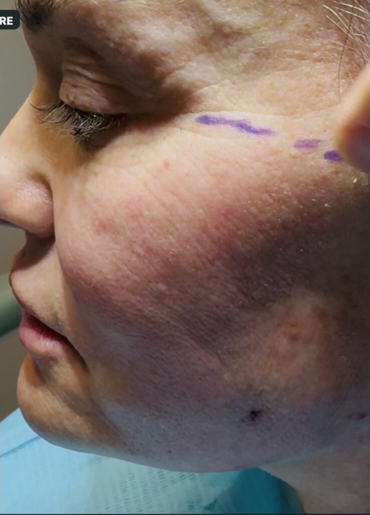 Endolift with suture suspension — two months after treatment — before