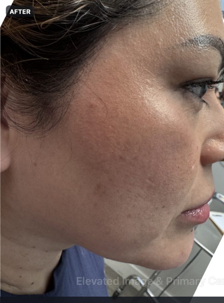 Endolift with suture suspension — two months after treatment, right profile — after