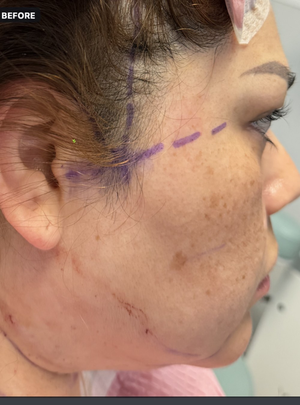Endolift with suture suspension — two months after treatment, right profile — before