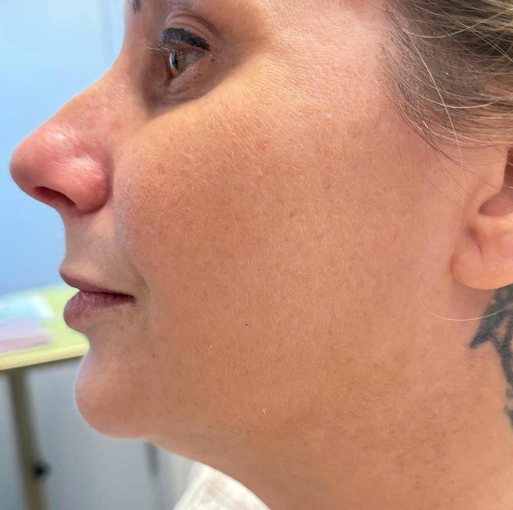 eic endolift 09 after