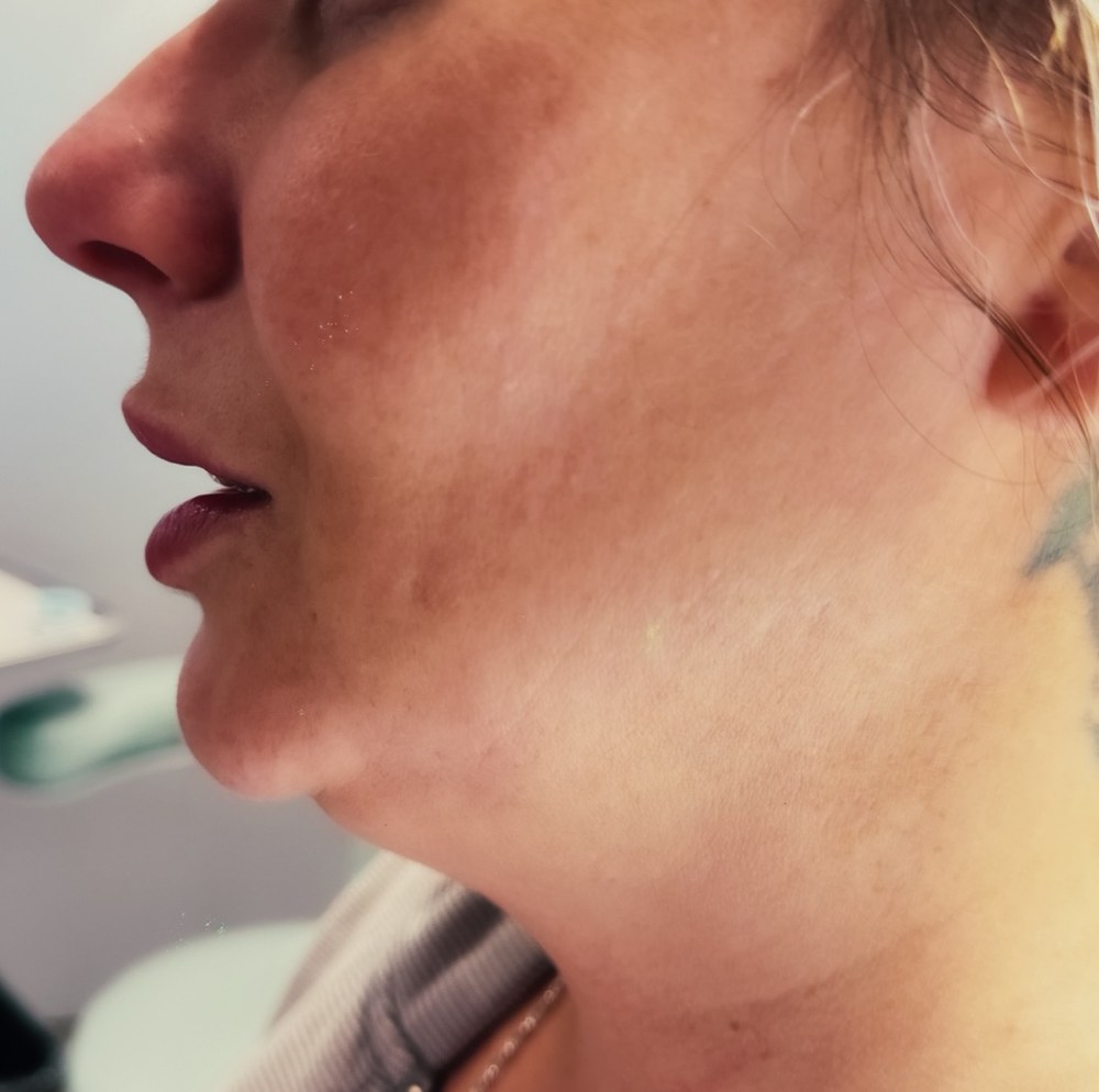 eic endolift 09 before