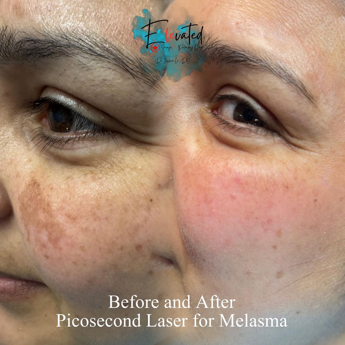 eic melasma splitface