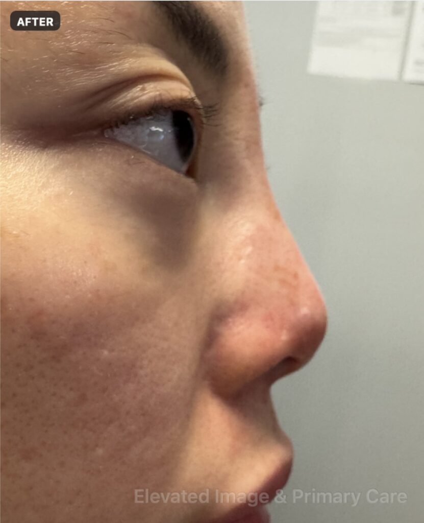 eic nosethread 01 after