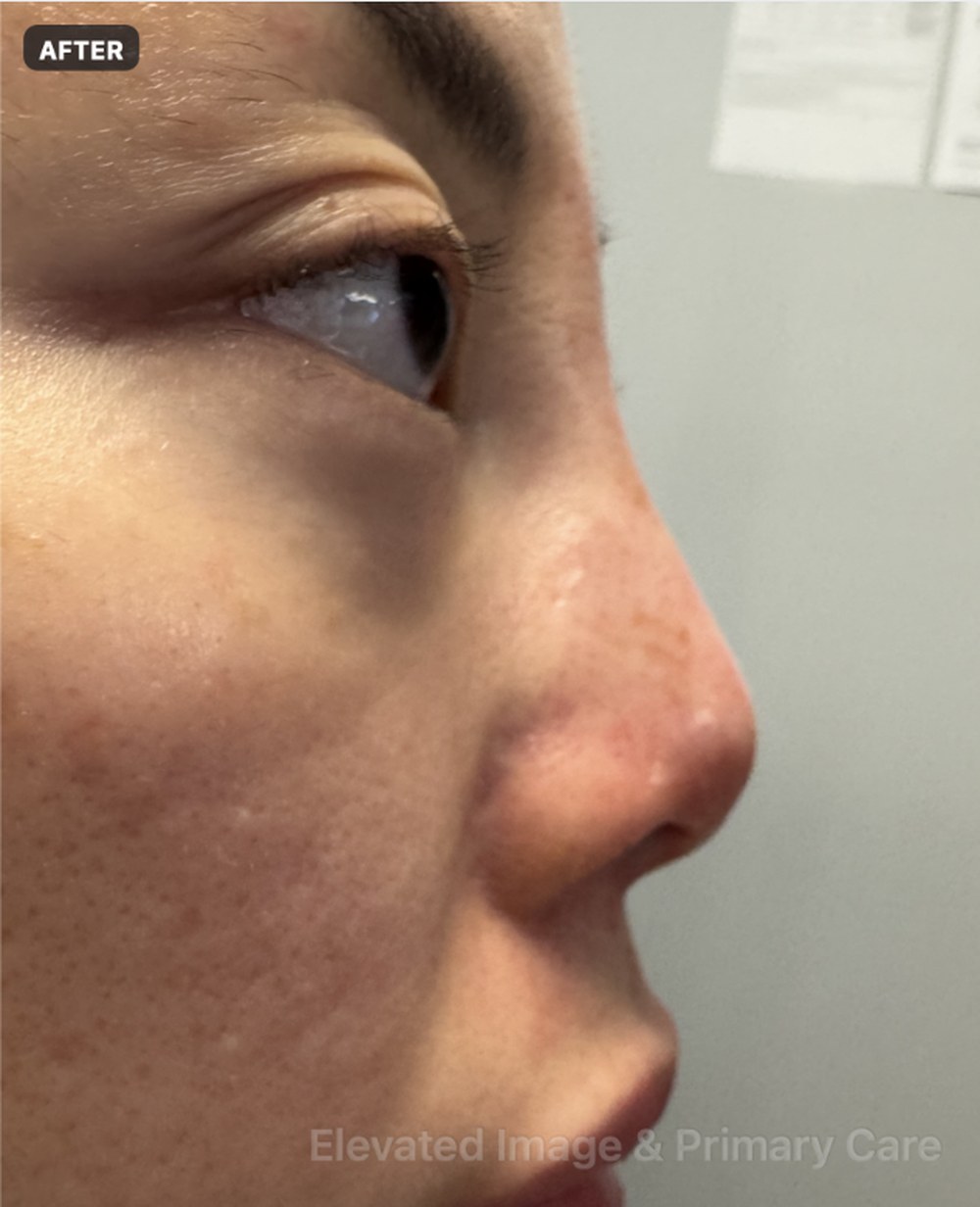 eic nosethread 01 after