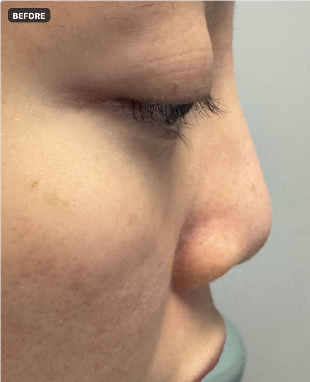 eic nosethread 01 before
