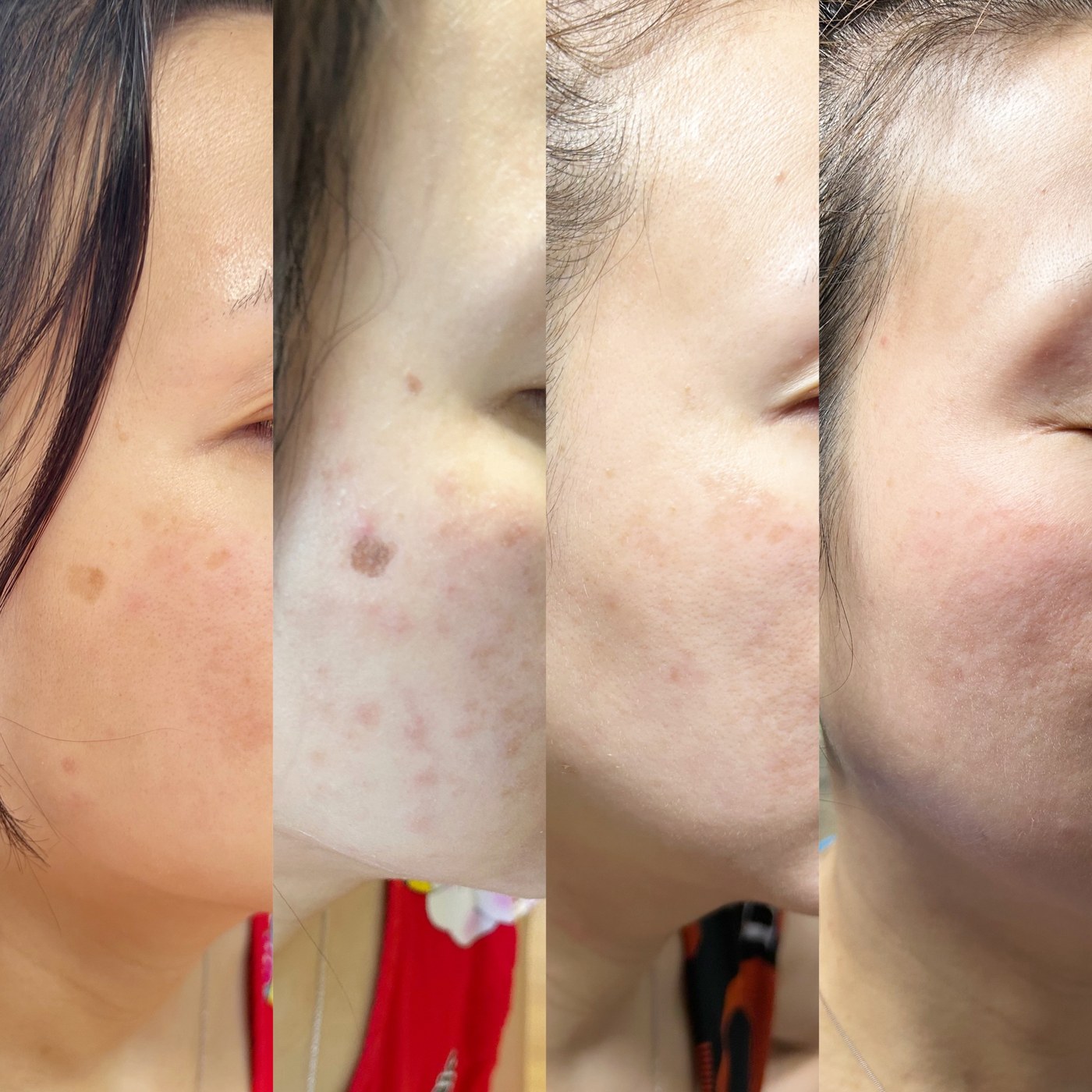 eic pigment progression