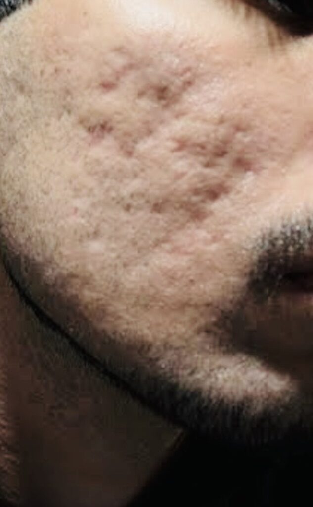 eic subcision view1 before