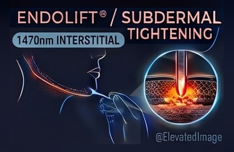 eic v2 01 endolift subdermal tightening r2
