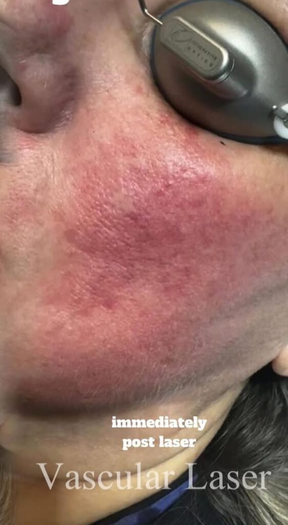 eic vascular laser after