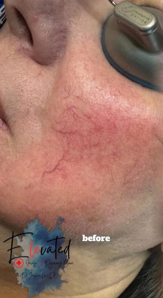 eic vascular laser before