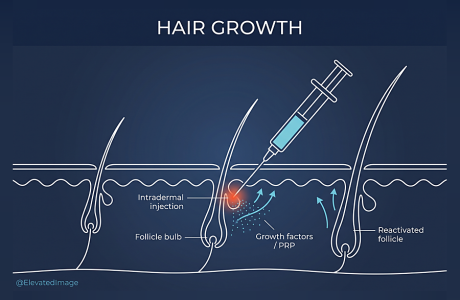 eic-hair-growth-injection